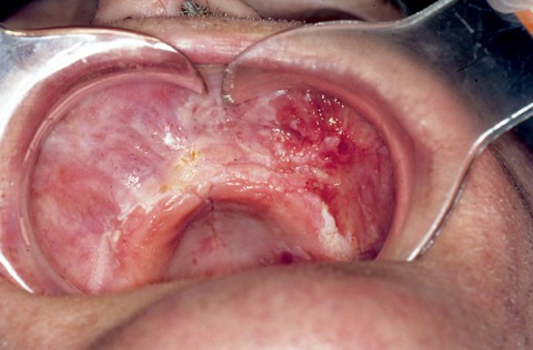 Patienten har cancer i överkäken. Nästan all oral cancer är skivepitelcancer.