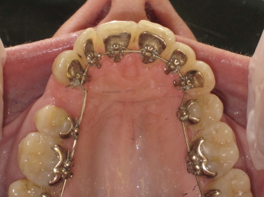 Lingual ortodonti – eftertraktad men kostsam