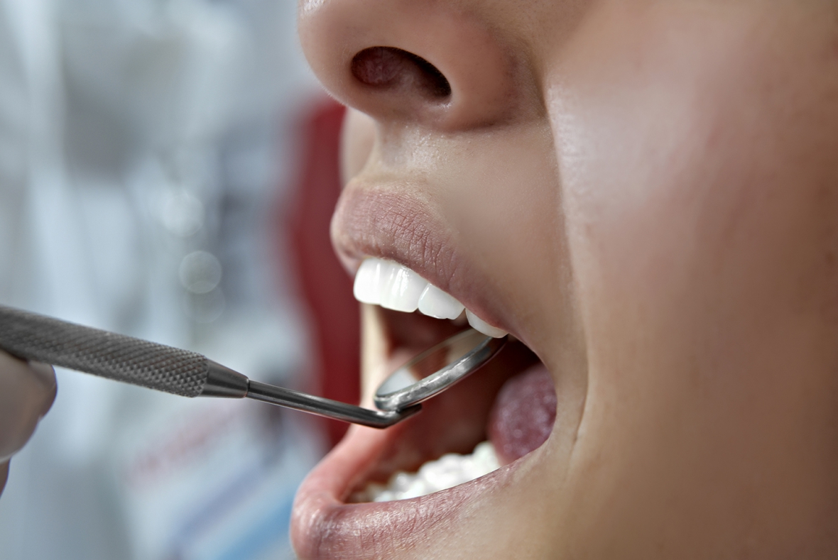Mekanismen bakom dentinkaries klarnar