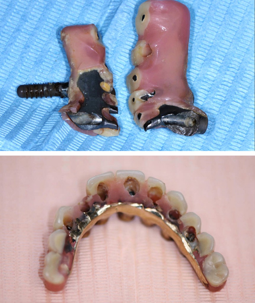 4. Havererade implantatbroar (notera brottytorna på övre bilden) som utsatts för stora krafter. För att lösa problemet med de nedslitna tänderna, se nedre bilden, krävs en höjning av hela bettet, det räcker inte med att höja enbart några få tänder. Alla akryltänder byttes ut.