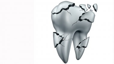 Sju av tio tänder med sprickor kan räddas