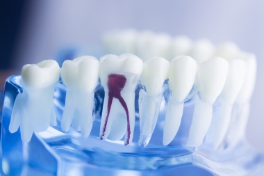 Risk att tandläkare saknar insikt om sina brister i endodonti