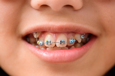 Barn och föräldrar inte alltid överens om tandreglering