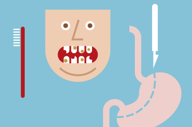 Missa inte munhälsan efter överviktskirurgi