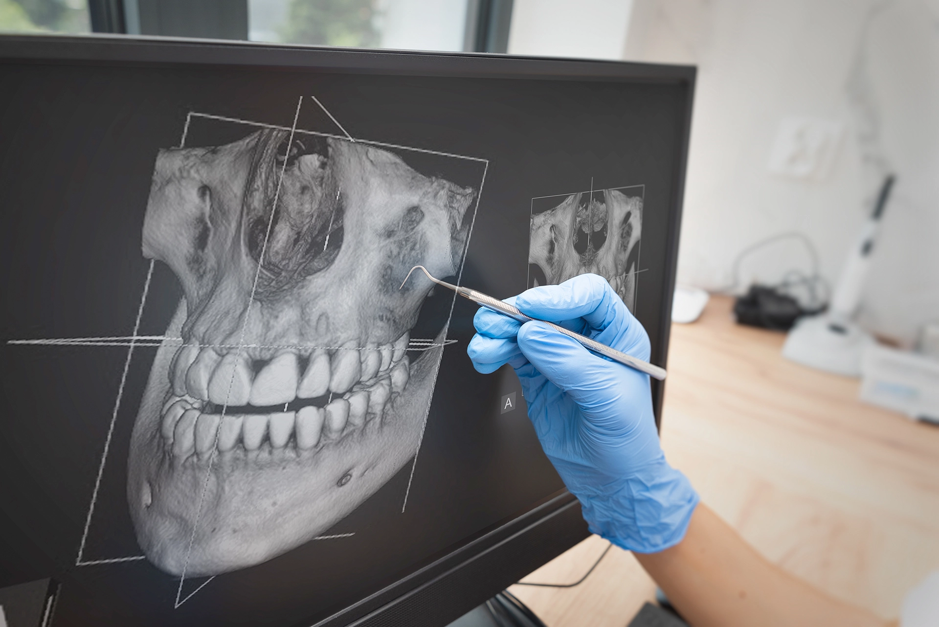 CBCT bättre än panoramaröntgen för att förebygga nervskador vid extraktion