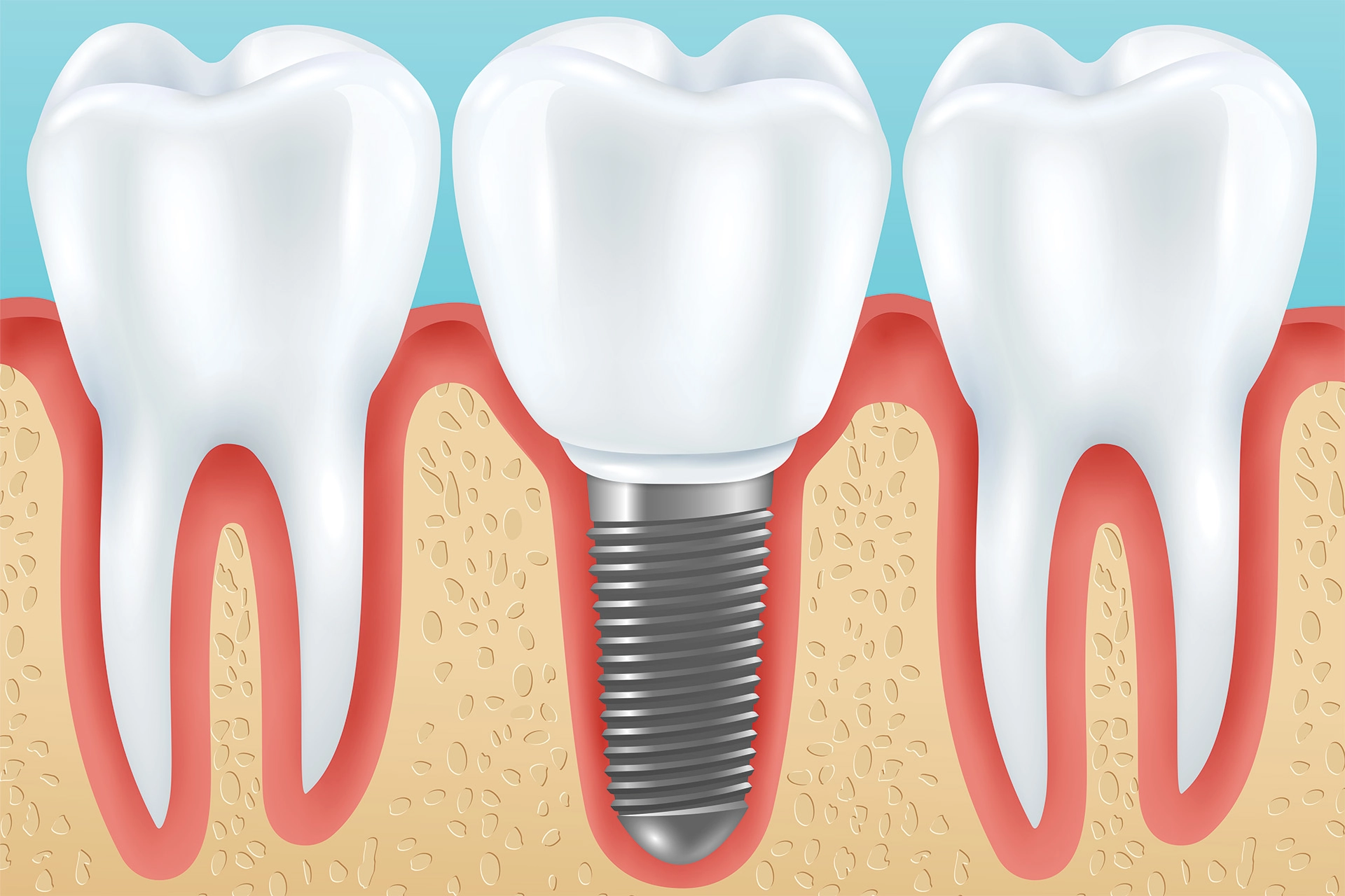 Individanpassning viktigt för lyckad implantatbehandling