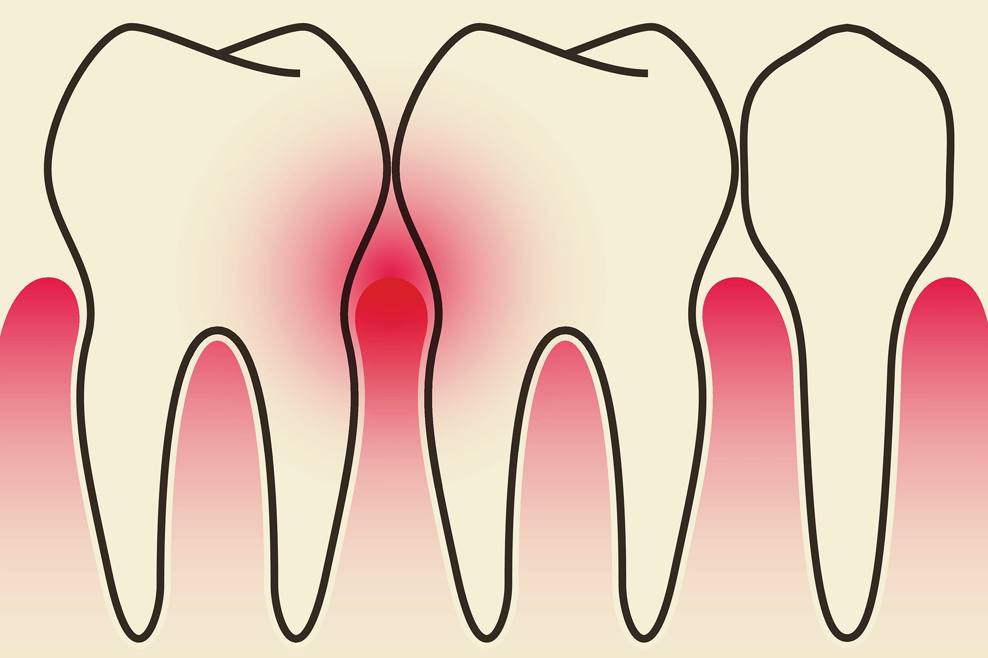 Behandling mot parodontit mindre effektivt än förmodat