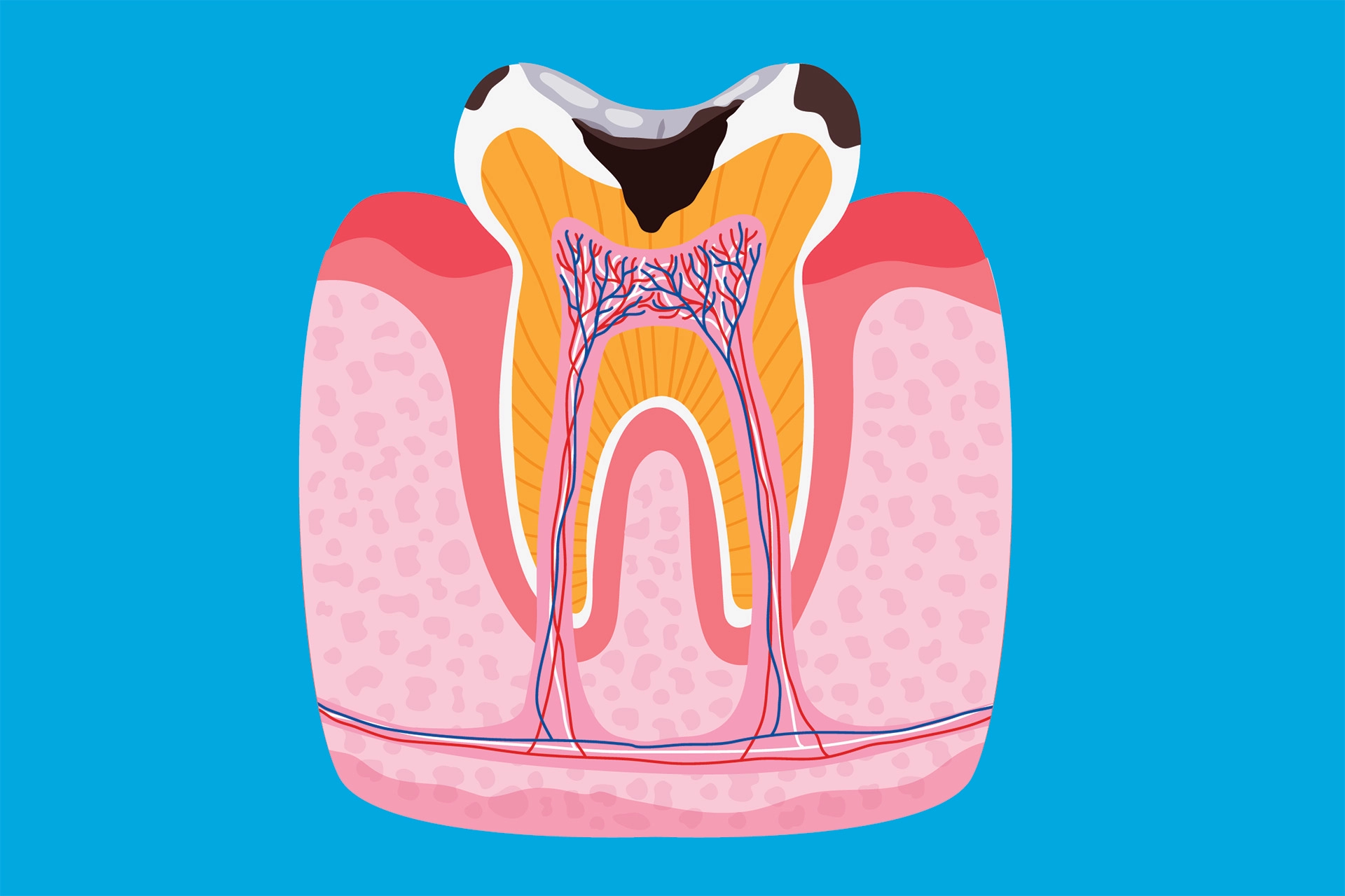 Indirekt överkappning har tydlig effekt  på pulpans vitalitet