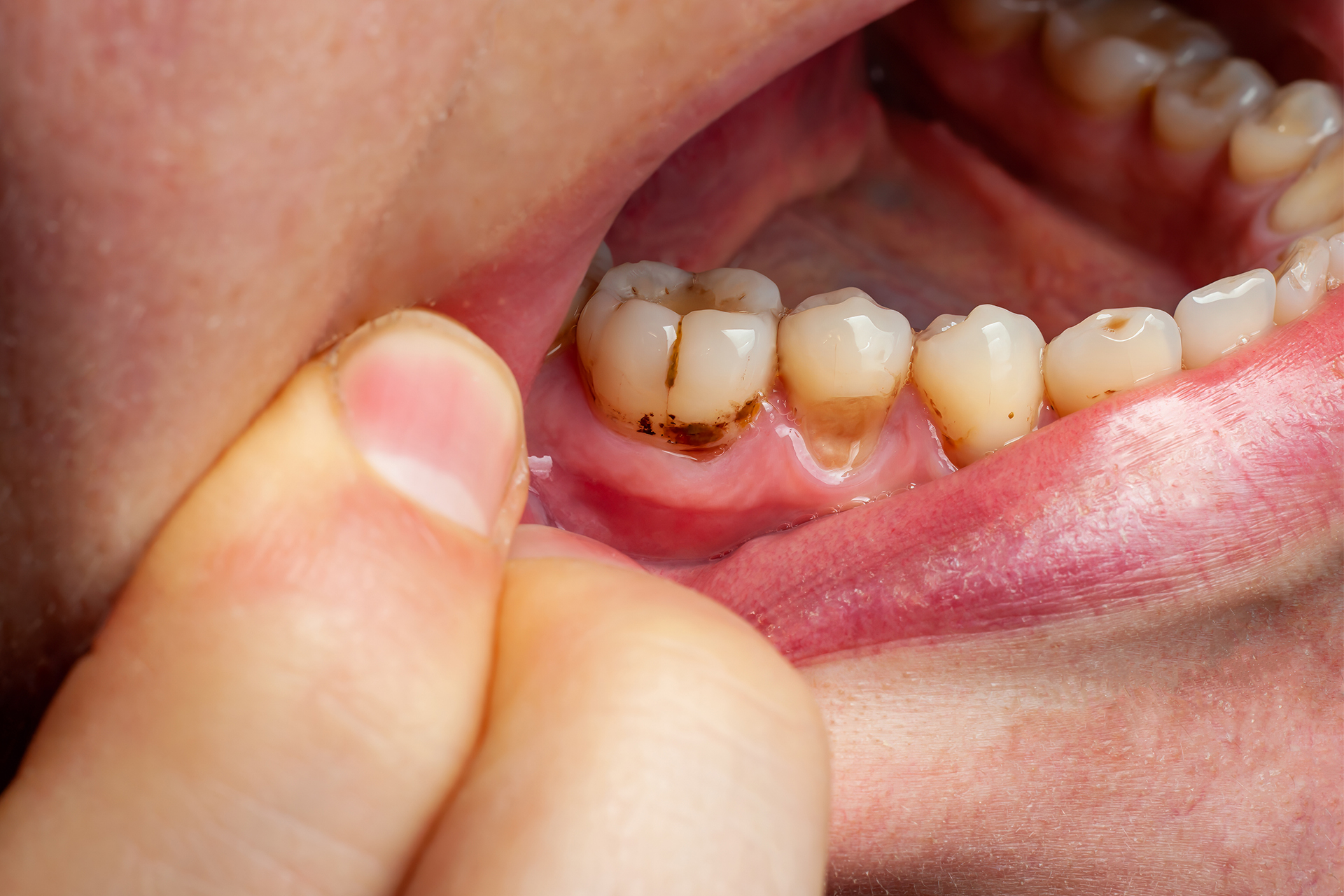 Brister i kariesbehandling av barn – Ivo kritiserar tandläkare