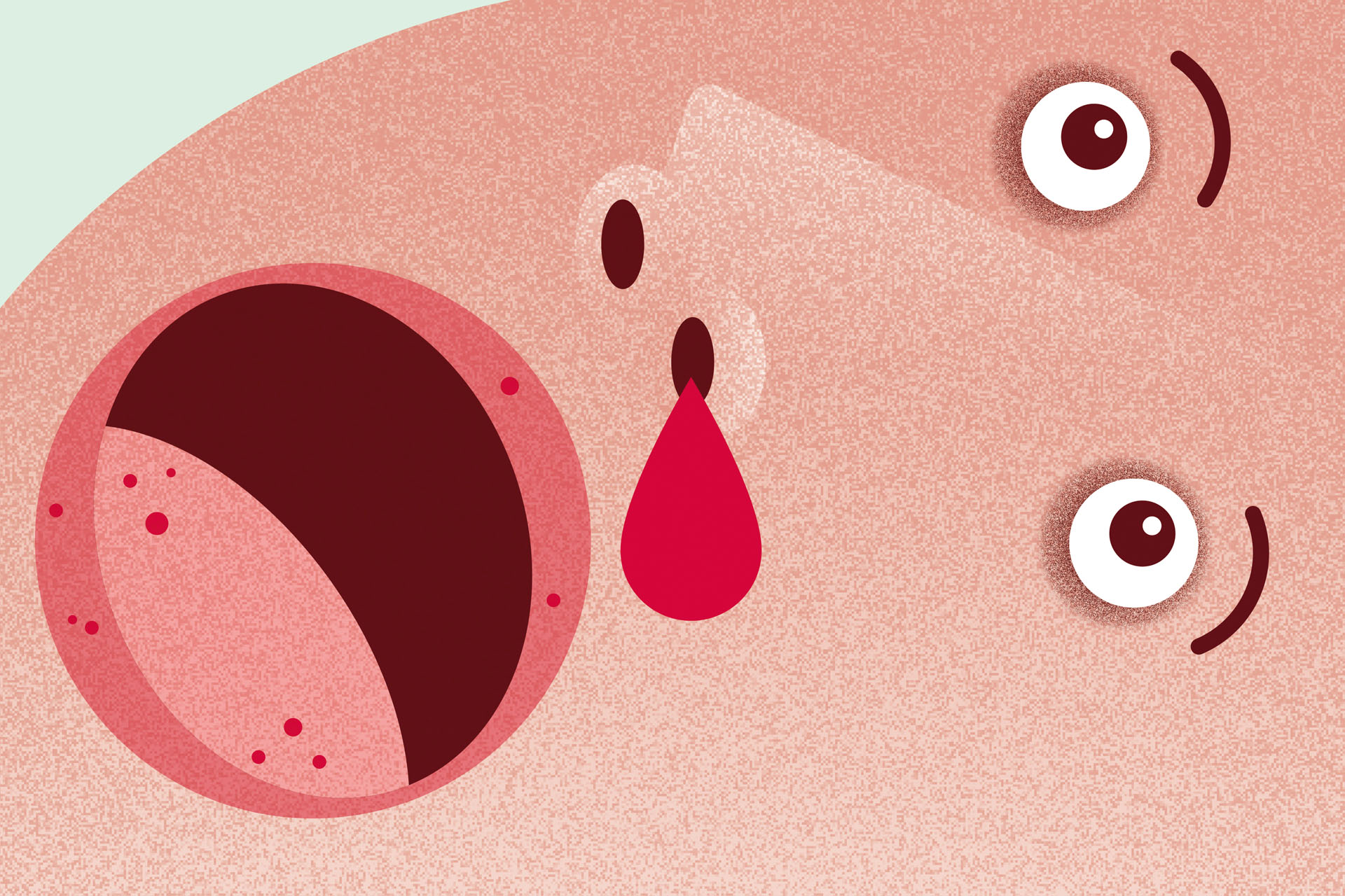 Så ser du tecken på Oslers ­sjukdom hos din patient